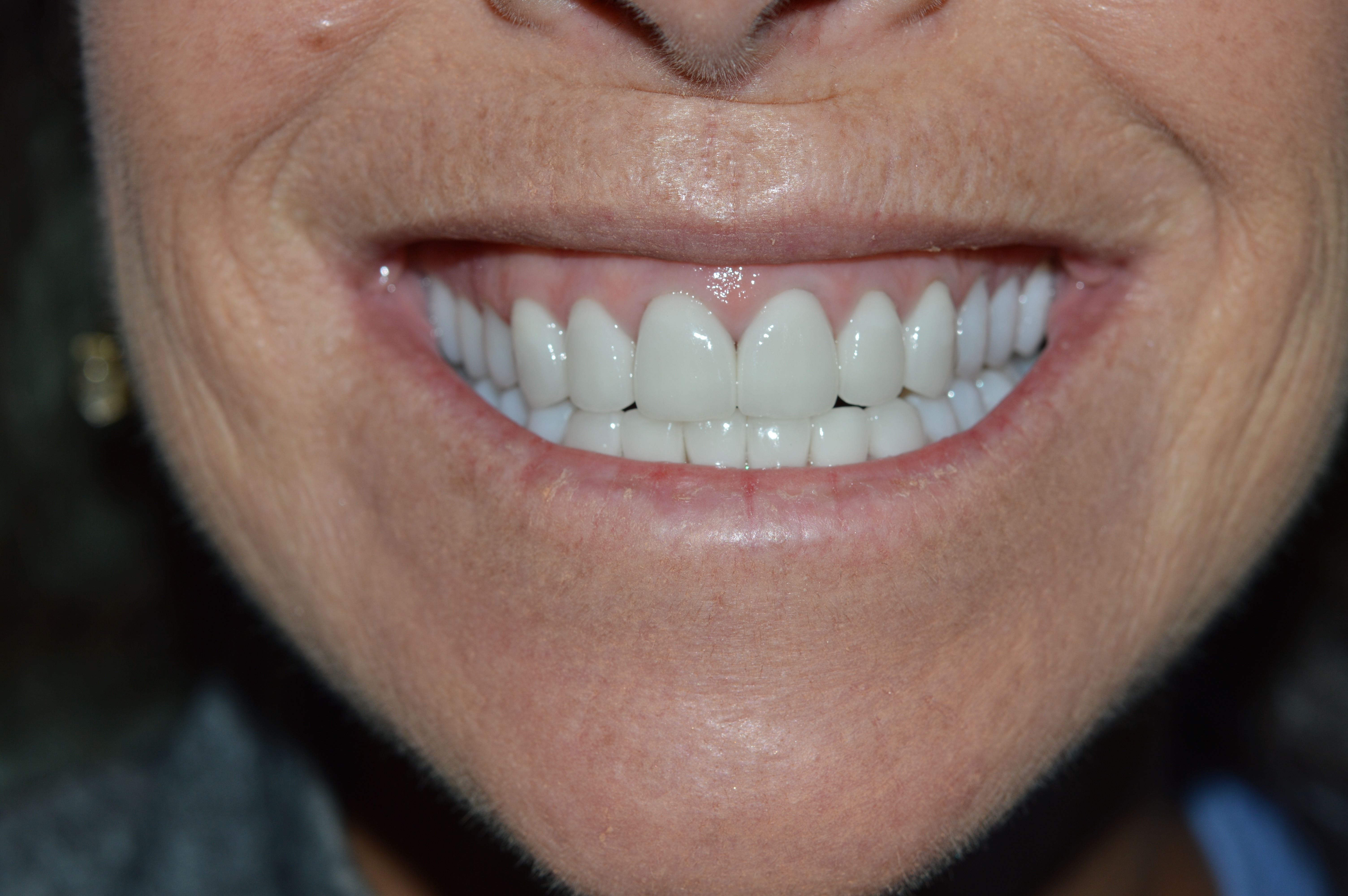 Cosmetic dentistry patient near Cincinnati, Milford, Loveland, Goshen, Indian Hill, Montgomery, and Clermont County OH.