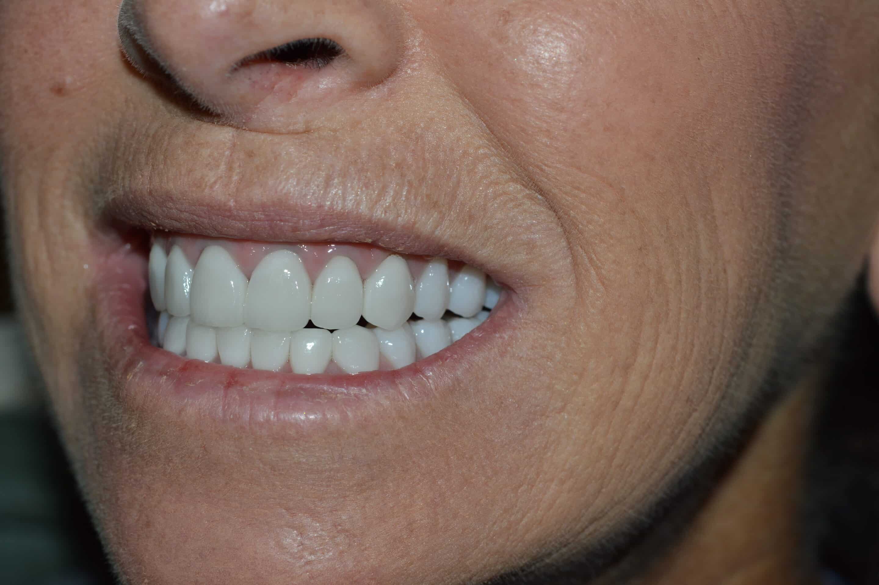 Cosmetic dentistry patient near Cincinnati, Milford, Loveland, Goshen, Indian Hill, Montgomery, and Clermont County OH.