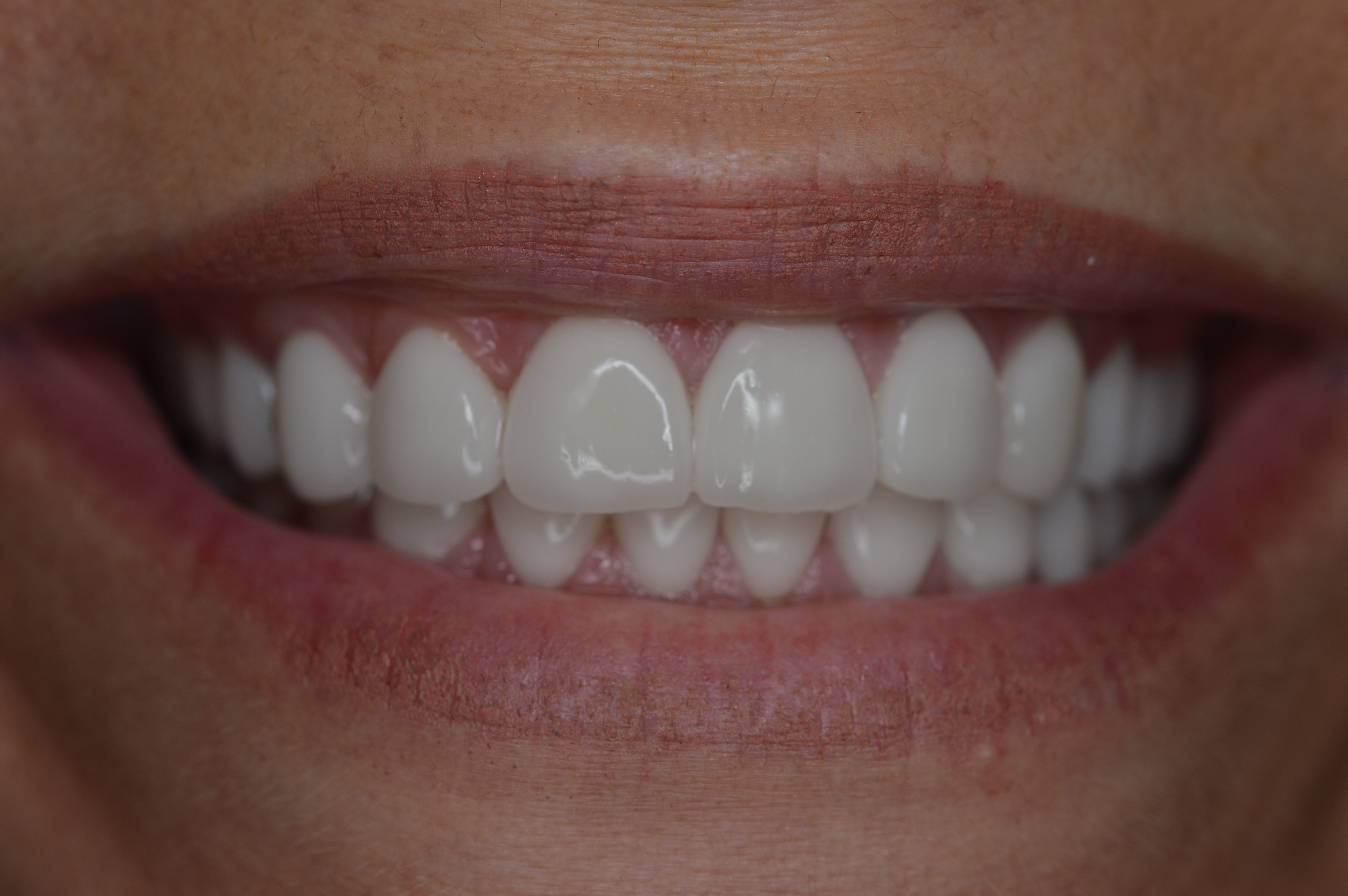 Cosmetic dentistry patient near Cincinnati, Milford, Loveland, Goshen, Indian Hill, Montgomery, and Clermont County OH.
