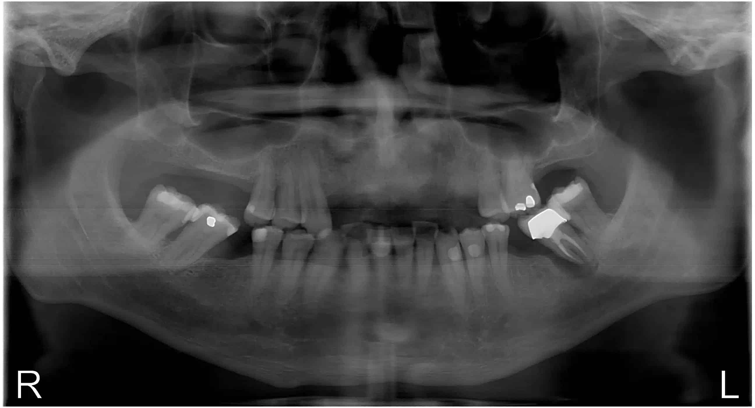 Dental x-ray